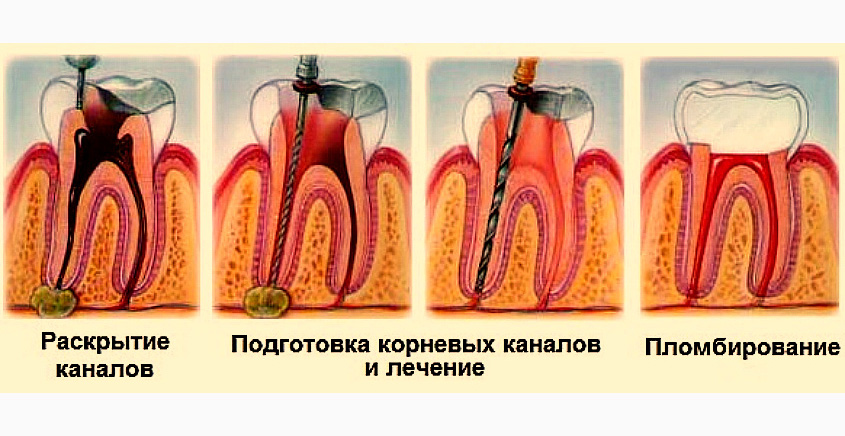 Лечение кисты