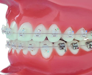 Брекеты Expirience ceramic
