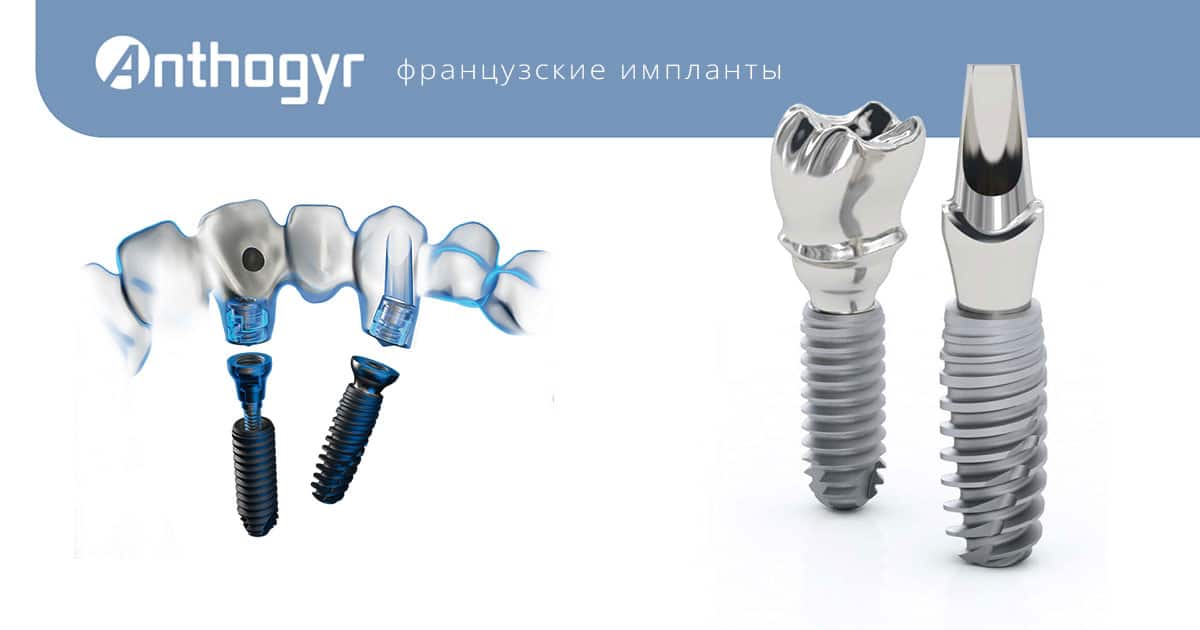 Имплант Antogyr (Франция)