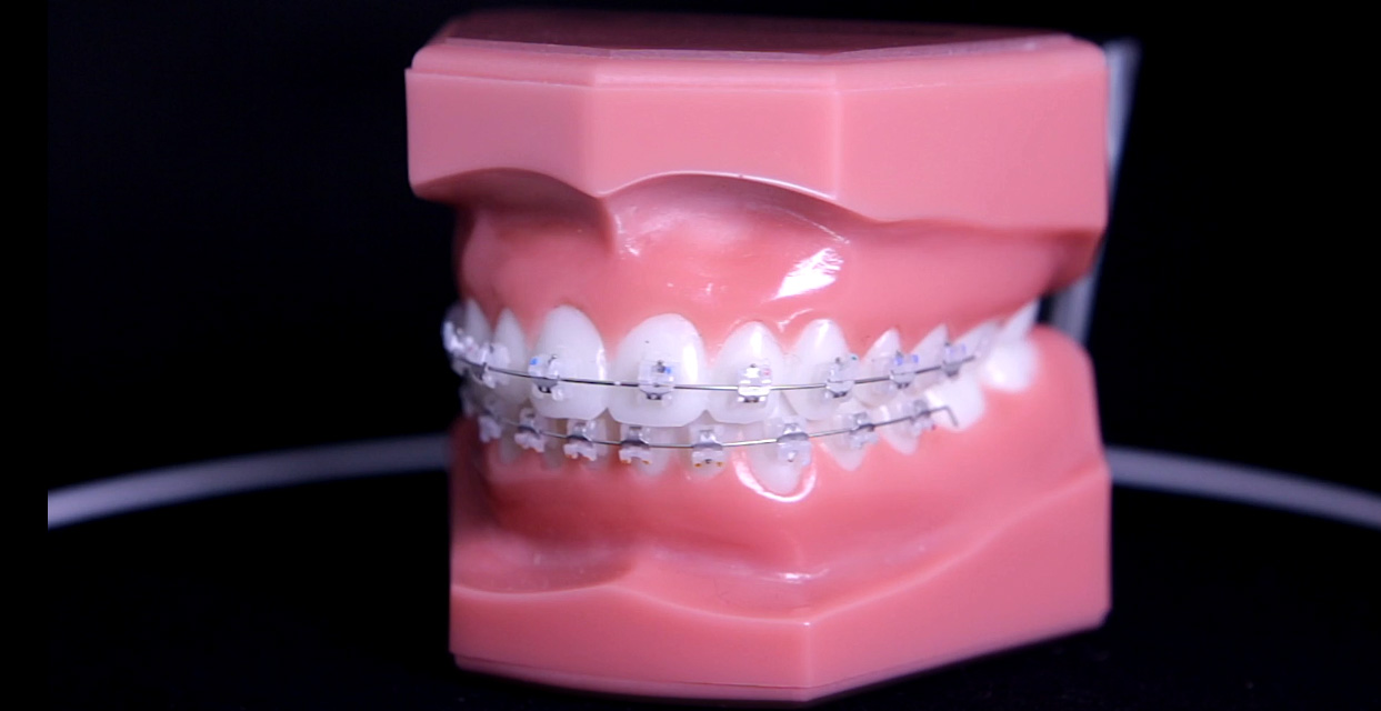 Брекеты Expirience ceramic