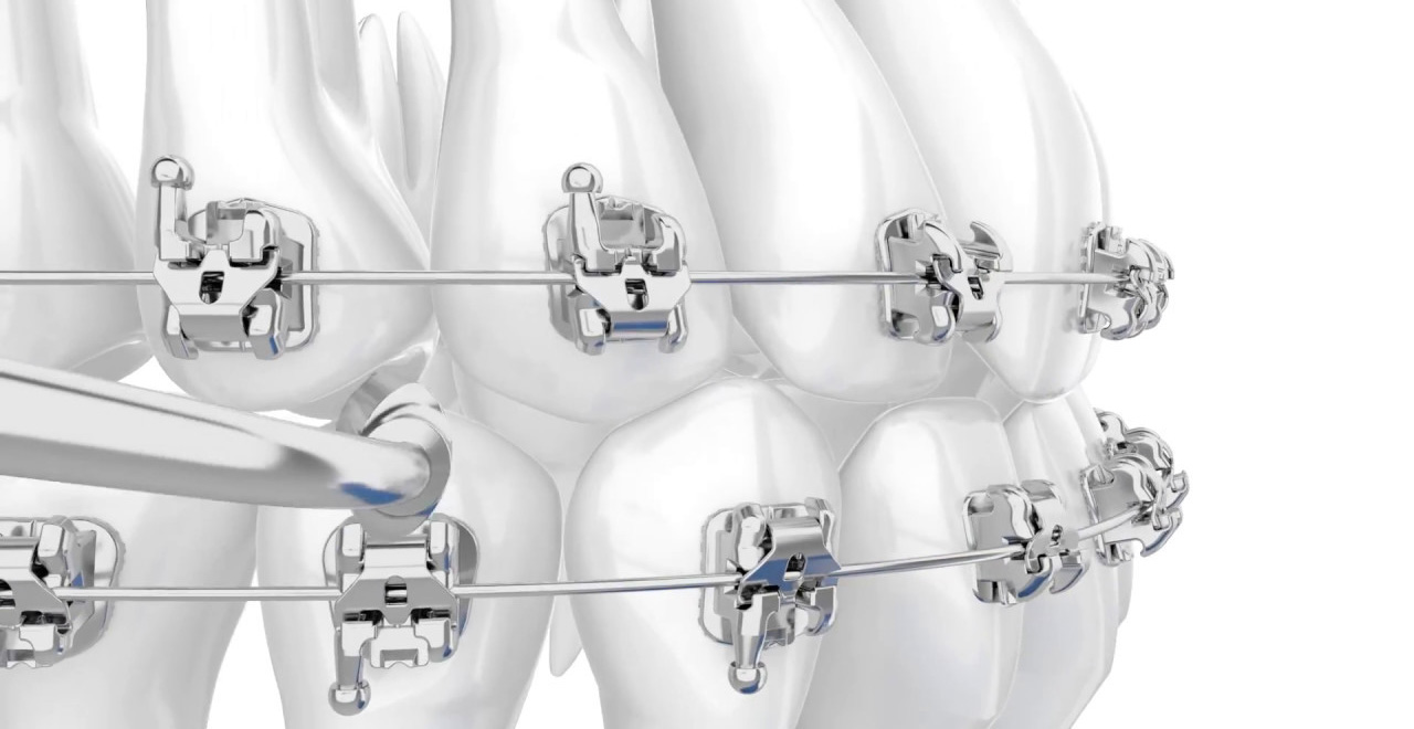 Experience Metal (GC orthodontics)