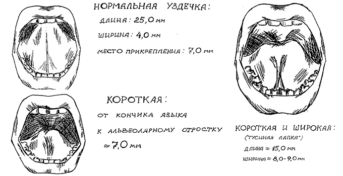 Подрезание уздечки языка