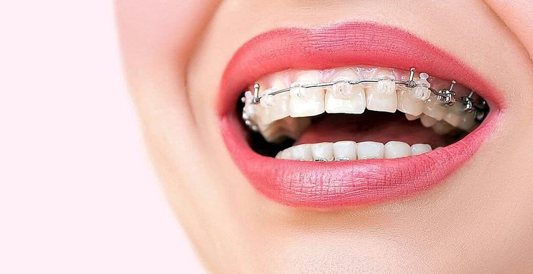 Брекеты Mistique (Dentsply GAC)