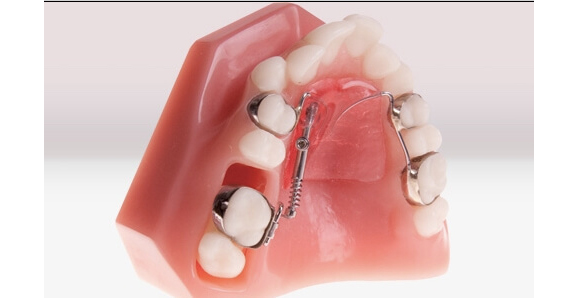 Аппарат Distal Jet