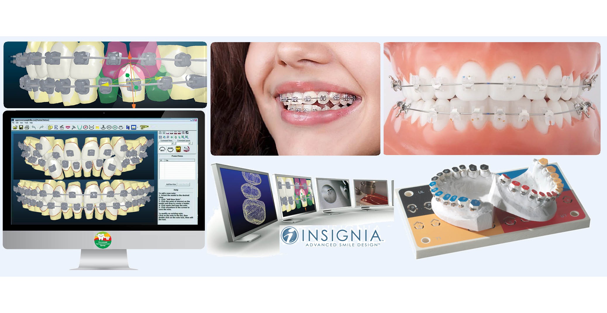 Индивидуальные брекеты  Insignia