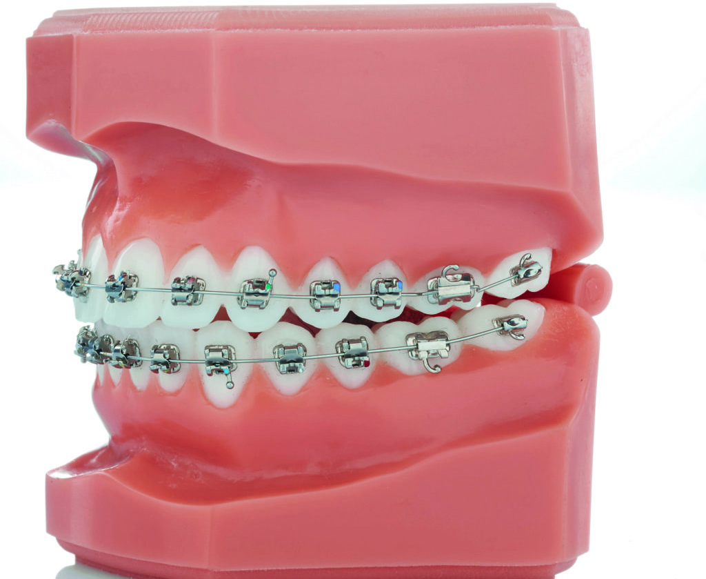 Experience Metal (GC orthodontics) 