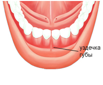 Подрезание уздечки губы