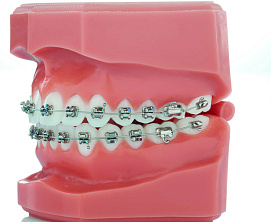 Experience Metal (GC orthodontics)