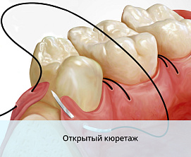 Открытый и закрытый кюретаж
