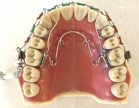 Аппарат Quad Helix